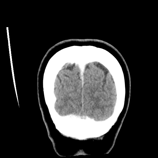 Cerebellar metastasis (cystic appearance) (Radiopaedia 41395-44258 D 56).png
