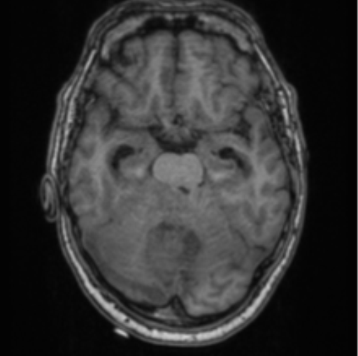 Cerebellar metastasis from lung adenocarcinoma (Radiopaedia 86690-102829 Axial T1 31).png