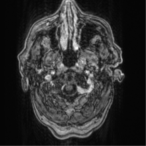 Cerebellar metastasis from lung adenocarcinoma (Radiopaedia 86690-102829 Axial T1 C+ 6).png
