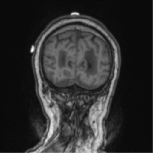 Cerebellar metastasis from lung adenocarcinoma (Radiopaedia 86690-102829 Coronal T1 14).png