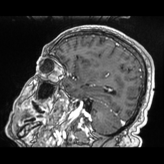 Cerebellar metastasis of pulmonary adenocarcinoma, cavernous venous malformation, and developmental venous anomaly (Radiopaedia 85827-101661 Sagittal T1 C+ 66).jpg