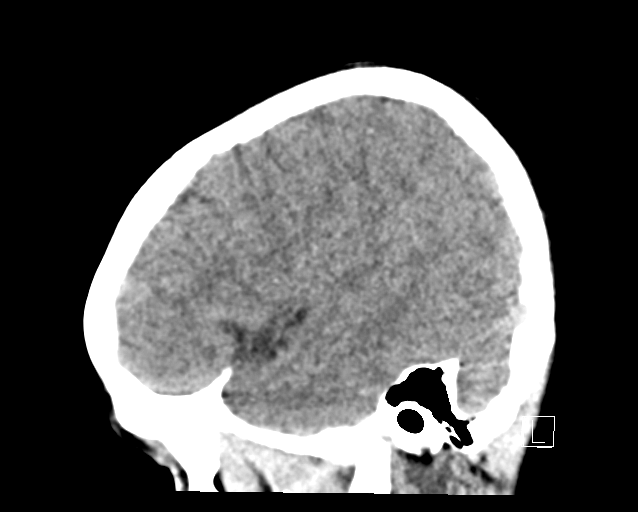 File:Cerebellar stroke (Radiopaedia 32202-33149 B 5).png