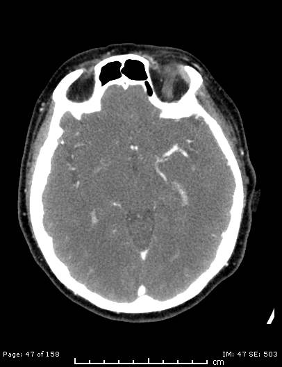Cerebellar strokes due to intracranial giant cell arteritis (Radiopaedia 68799-78510 CT angiogram 47).jpg