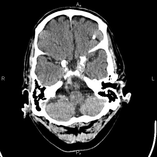 Cerebellopontine angle arachnoid cyst (Radiopaedia 85149-100704 Axial With contrast 9).jpg