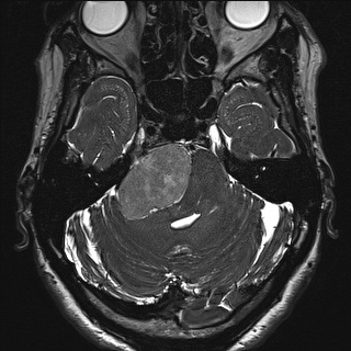 Cerebellopontine angle meningioma (Radiopaedia 72983-83680 Axial FIESTA 38).jpg