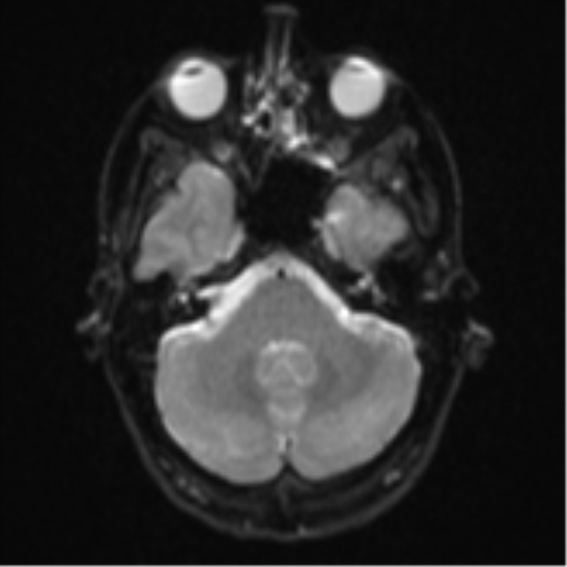 File:Cerebral abscess (Radiopaedia 60342-68009 Axial DWI 8).png