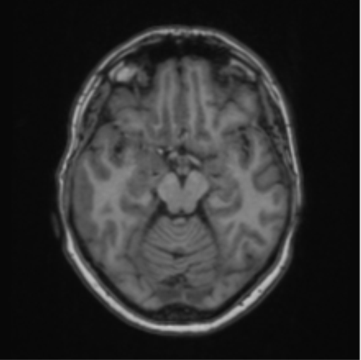 File:Cerebral abscess from pulmonary arteriovenous malformation (Radiopaedia 86275-102291 Axial T1 31).png