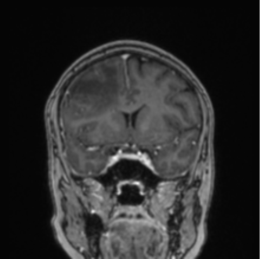 Cerebral abscess from pulmonary arteriovenous malformation (Radiopaedia 86275-102291 L 57).png