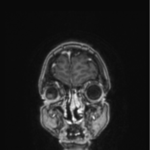 Cerebral abscess from pulmonary arteriovenous malformation (Radiopaedia 86275-102291 L 81).png