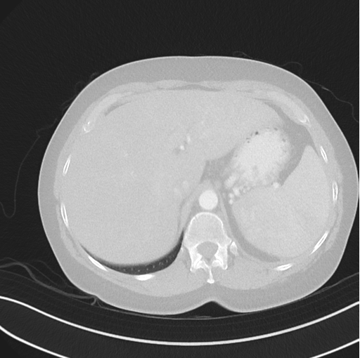 File:Cerebral abscess from pulmonary arteriovenous malformation (Radiopaedia 86275-102292 Axial lung window 56).png
