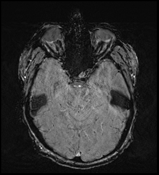 Cerebral abscess with ventriculitis (Radiopaedia 78965-91878 Axial SWI 21).jpg