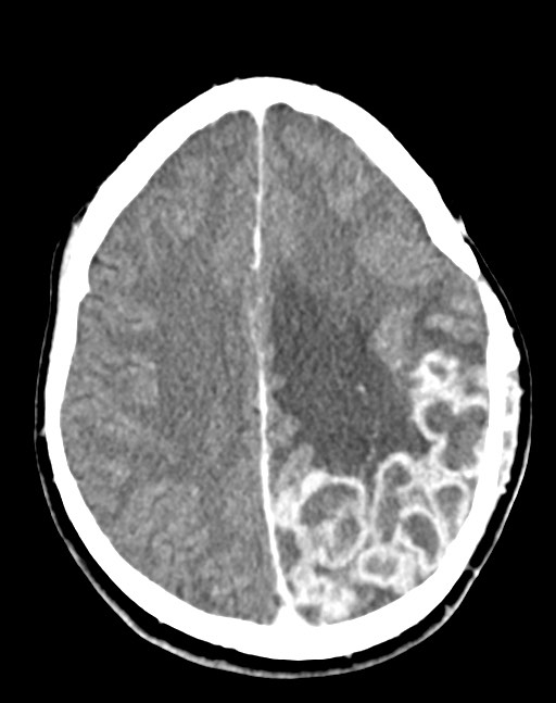 Cerebral abscesses (Radiopaedia 70458-80568 Axial Contrast 42).jpg