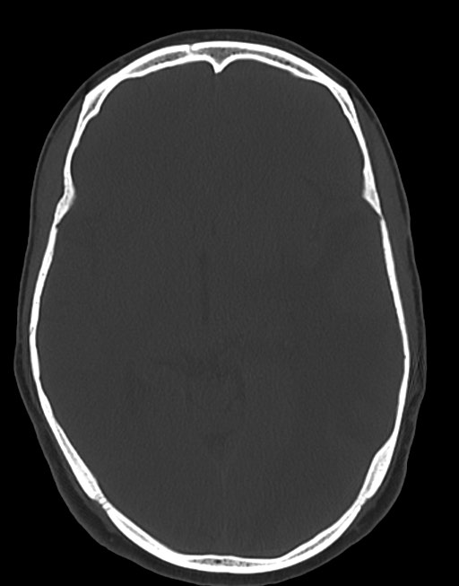 Cerebral abscesses (Radiopaedia 70458-80568 Axial bone window 30).jpg
