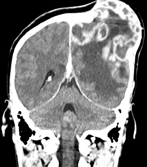 Cerebral abscesses (Radiopaedia 70458-80568 Coronal Contrast 45).jpg