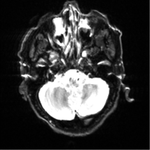 File:Cerebral amyloid angiopathy (Radiopaedia 46082-50433 Axial DWI 5).png