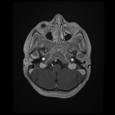 Cerebral and spinal tuberculosis (Radiopaedia 90489-107837 Axial T1 C+ 48).jpg