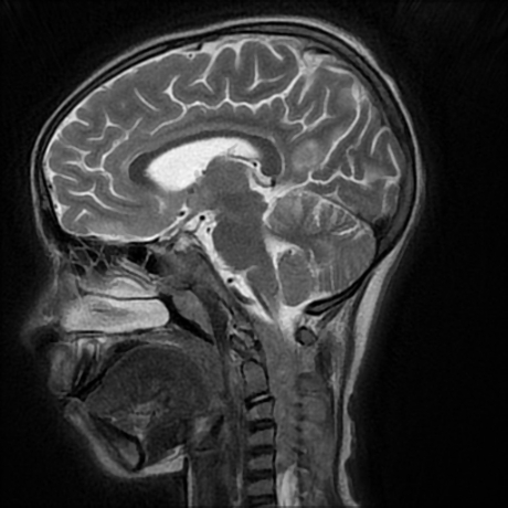 File:Cerebral and spinal tuberculosis (Radiopaedia 90489-107837 Sagittal T2 12).jpg