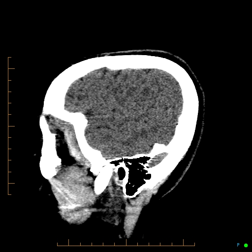 Cerebral arteriovenous malformation (AVM) (Radiopaedia 78162-90706 A 65).jpg