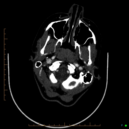 Cerebral arteriovenous malformation (AVM) (Radiopaedia 78162-90706 Axial CTA 45).jpg