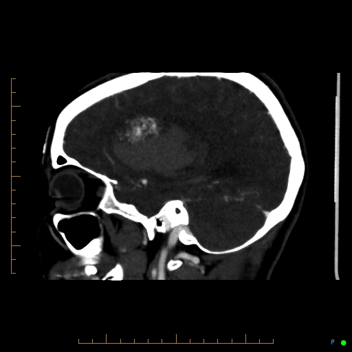 Cerebral arteriovenous malformation (AVM) (Radiopaedia 78162-90706 Sagittal CTA 26).jpg
