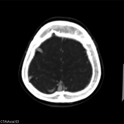 Cerebral arteriovenous malformation (Radiopaedia 28518-28759 B 53).jpg