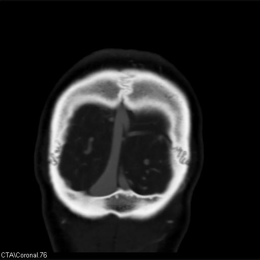 Cerebral arteriovenous malformation (Radiopaedia 28518-28759 C 76).jpg