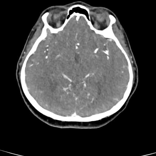 Cerebral arteriovenous malformation (Radiopaedia 73830-84645 B 56).jpg