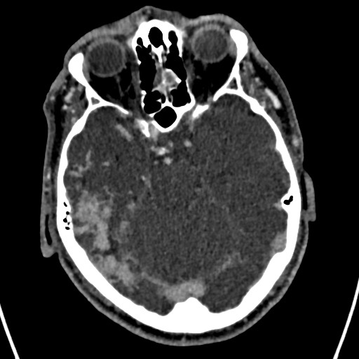 Cerebral arteriovenous malformation (Radiopaedia 78188-90746 Axial C+ delayed 59).jpg