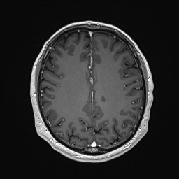 Cerebral arteriovenous malformation (Radiopaedia 84015-99245 Axial T1 C+ 106).jpg