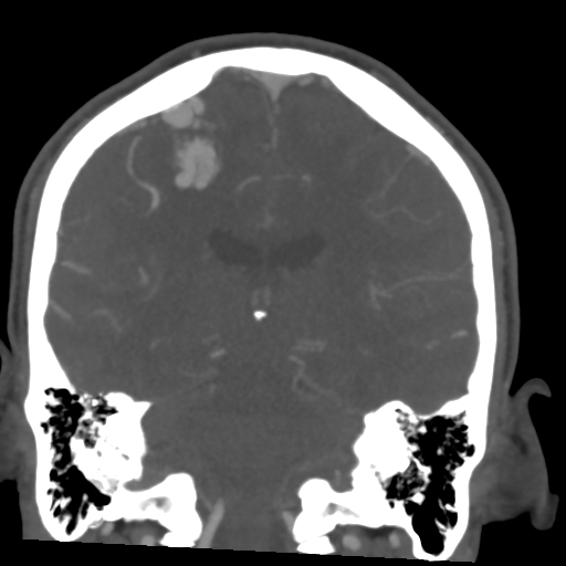 Cerebral arteriovenous malformation (Spetzler-Martin grade 2) (Radiopaedia 41262-44076 F 39).png