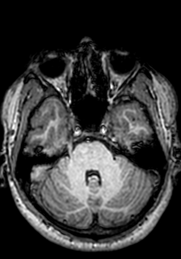 Cerebral arteriovenous malformation at posterior body of corpus callosum (Radiopaedia 74111-84925 Axial T1 228).jpg