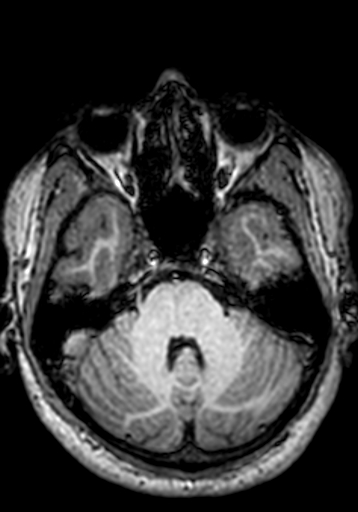 Cerebral arteriovenous malformation at posterior body of corpus callosum (Radiopaedia 74111-84925 Axial T1 231).jpg
