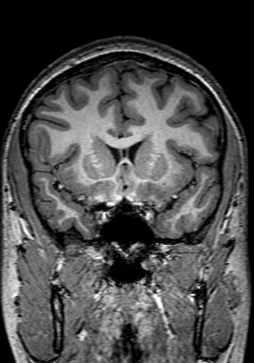 Cerebral arteriovenous malformation at posterior body of corpus callosum (Radiopaedia 74111-84925 Coronal T1 109).jpg