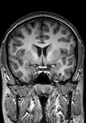 Cerebral arteriovenous malformation at posterior body of corpus callosum (Radiopaedia 74111-84925 Coronal T1 130).jpg