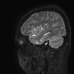 Cerebral arteriovenous malformation at posterior body of corpus callosum (Radiopaedia 74111-84925 Sagittal T2 24).jpg