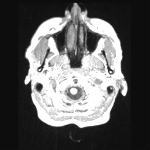 Cerebral arteriovenous malformation with hemorrhage (Radiopaedia 34422-35737 Axial T1 5).png