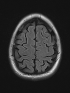 File:Cerebral cavernoma and development venous anomaly (Radiopaedia 37603-39482 Axial FLAIR 19).png