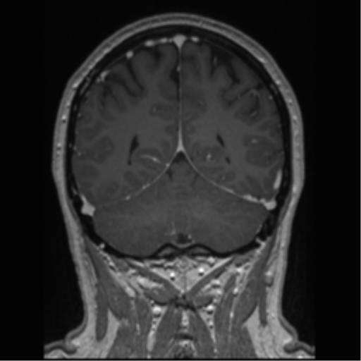 Cerebral cavernoma and development venous anomaly (Radiopaedia 37603-39482 Coronal T1 C+ 29).png