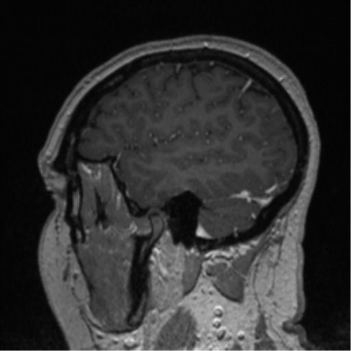 Cerebral cavernoma and development venous anomaly (Radiopaedia 37603-39482 Sagittal T1 C+ 22).png