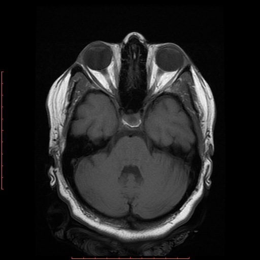 File:Cerebral cavernous malformation (Radiopaedia 26177-26306 Axial T1 7).jpg