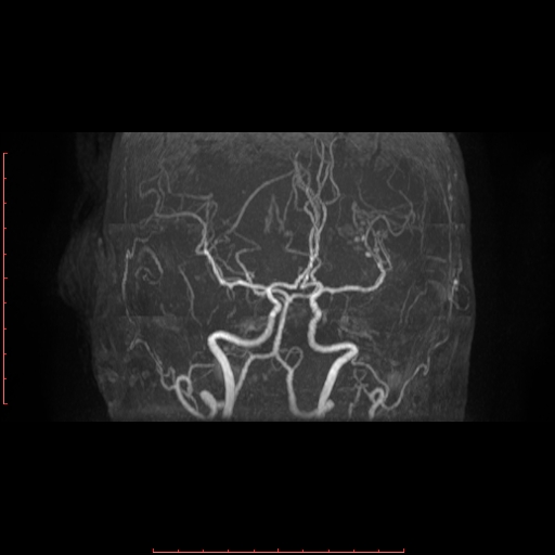 File:Cerebral cavernous malformation (Radiopaedia 26177-26306 MRA 12).jpg