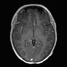 Cerebral cavernous venous malformation (Radiopaedia 70008-80021 Axial T1 C+ 33).jpg