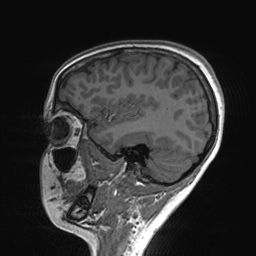 File:Cerebral cavernous venous malformation (Radiopaedia 70008-80021 Sagittal T1 56).jpg