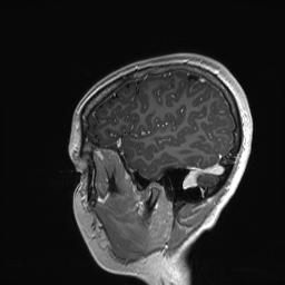 File:Cerebral cavernous venous malformation (Radiopaedia 70008-80021 Sagittal T1 C+ 60).jpg