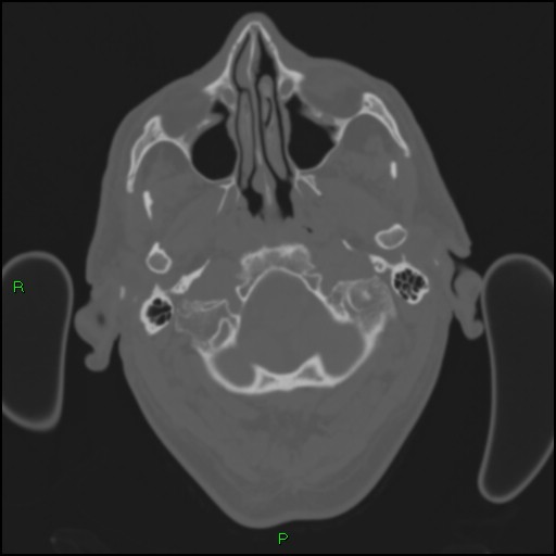 Cerebral contusions (Radiopaedia 33868-35039 Axial bone window 17).jpg