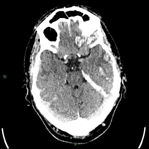 Cerebral contusions (Radiopaedia 33868-35039 Axial non-contrast 68).jpg