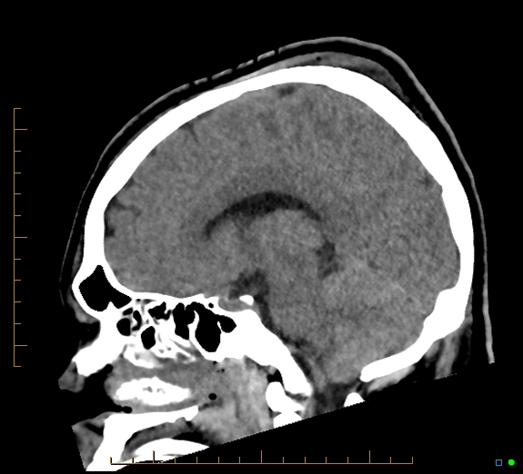 Cerebral fat embolism (Radiopaedia 85521-101224 C 29).jpg