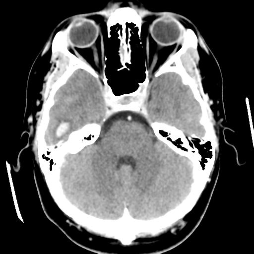 File:Cerebral hemorrhage secondary to arteriovenous malformation (Radiopaedia 33497-34561 B 16).png