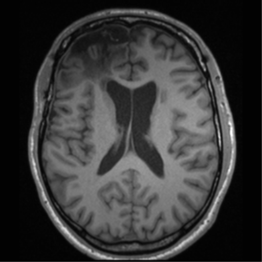 File:Cerebral hemorrhagic contusions- temporal evolution (Radiopaedia 40224-42757 Axial T1 45).png