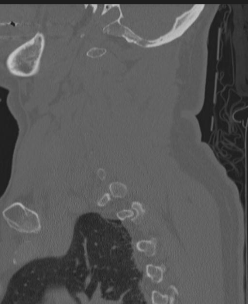 Cerebral hemorrhagic contusions and cervical spine fractures (Radiopaedia 32865-33841 Sagittal bone window 75).jpg
